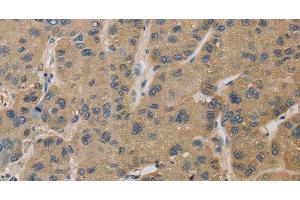 Immunohistochemistry of paraffin-embedded Human liver cancer tissue using TBXAS1 Polyclonal Antibody at dilution 1:30 (TBXAS1 anticorps)