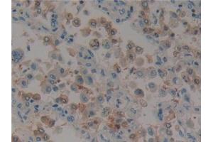 Detection of PXN in Human Lung cancer Tissue using Polyclonal Antibody to Paxillin (PXN)