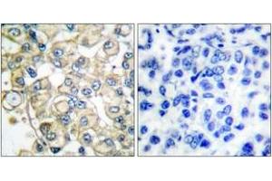 Immunohistochemistry analysis of paraffin-embedded human breast carcinoma tissue, using FGFR1 Oncogene Partner Antibody. (FGFR1OP anticorps  (AA 341-390))