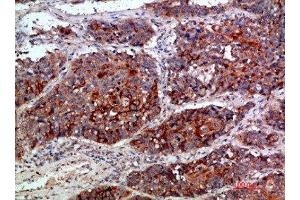 Immunohistochemical analysis of paraffin-embedded human-lung-cancer, antibody was diluted at 1:200 (MLL/KMT2A anticorps  (AA 3850-3900))