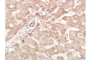 Paraformaldehyde-fixed, paraffin embedded human liver carcinoma tissue, Antigen retrieval by boiling in sodium citrate buffer(pH6) for 15min, Block endogenous peroxidase by 3% hydrogen peroxide for 30 minutes, Blocking buffer (normal goat serum) at 37°C for 20min, Antibody incubation with Rabbit Anti-ALDH1 Polyclonal Antibody, Unconjugated  at 1:400 overnight at 4°C, followed by a conjugated secondary and DAB staining