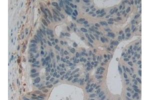 Detection of GSN in Human Colorectal cancer Tissue using Polyclonal Antibody to Gelsolin (GSN)