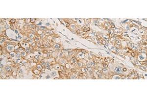 Immunohistochemistry of paraffin-embedded Human prost at e cancer tissue using HLA-DMB Polyclonal Antibody at dilution of 1:40(x200) (HLA-DMB anticorps)