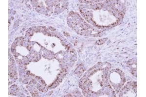 IHC-P Image Immunohistochemical analysis of paraffin-embedded NCIN87 xenograft, using fumarate hydratase , antibody at 1:500 dilution. (FH anticorps)
