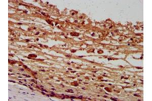 IHC image of ABIN7162587 diluted at 1:400 and staining in paraffin-embedded human melanoma performed on a Leica BondTM system. (Pannexin 2 anticorps  (AA 370-470))