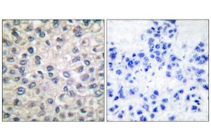 Immunohistochemical analysis of paraffin-embedded human breast carcinoma tissue, using Catenin- alpha antibody. (CTNNA1 anticorps  (C-Term))