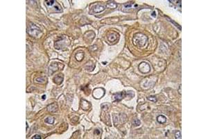 IHC analysis of FFPE human lung carcinoma tissue stained with TLR6 antibody