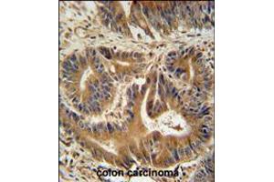 VPS52 antibody immunohistochemistry analysis in formalin fixed and paraffin embedded human colon carcinoma followed by peroxidase conjugation of the secondary antibody and DAB staining. (VPS52 anticorps  (C-Term))