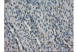 Immunohistochemical staining of paraffin-embedded Adenocarcinoma of breast tissue using anti-STK39 mouse monoclonal antibody.