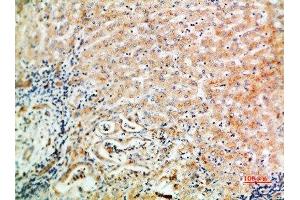 Immunohistochemical analysis of paraffin-embedded human-liver-cancer, antibody was diluted at 1:200