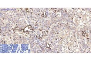 Immunohistochemistry of paraffin-embedded Human lung cancer tissue using CD45 Monoclonal Antibody at dilution of 1:200.