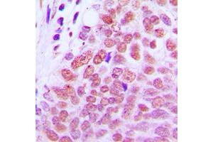 Immunohistochemical analysis of RXR gamma staining in human breast cancer formalin fixed paraffin embedded tissue section.