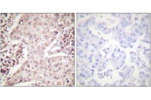 Immunohistochemistry analysis of paraffin-embedded human breast carcinoma, using Chk2 (Ab-387) Antibody. (CHEK2 anticorps  (AA 361-410))