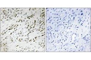 Immunohistochemistry analysis of paraffin-embedded human prostate carcinoma tissue, using TSH2 Antibody. (THNSL2 anticorps  (AA 811-860))