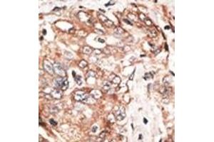 Formalin-fixed and paraffin-embedded human cancer tissue reacted with the primary antibody, which was peroxidase-conjugated to the secondary antibody, followed by DAB staining. (TPX2 anticorps  (AA 350-382))