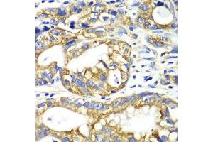 Immunohistochemistry of paraffin-embedded human gastric cancer using AK2 antibody. (Adenylate Kinase 2 anticorps  (AA 1-232))