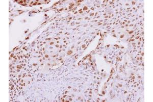 IHC-P Image Carboxypeptidase E antibody [N2C2], Internal detects Carboxypeptidase E protein at nucleus on human breast cancer by immunohistochemical analysis. (CPE anticorps)