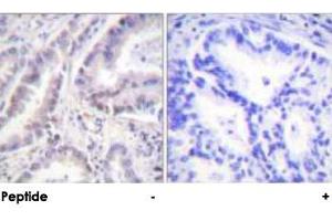 Immunohistochemical analysis of paraffin-embedded human lung carcinoma tissue using CDC6 polyclonal antibody . (CDC6 anticorps)