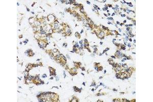 Immunohistochemistry of paraffin-embedded Human breast cancer using DHRS2 Polyclonal Antibody at dilution of 1:100 (40x lens). (DHRS2 anticorps)