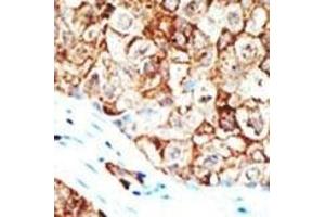 Formalin-fixed and paraffin-embedded human cancer tissue reacted with the primary antibody, which was peroxidase-conjugated to the secondary antibody, followed by AEC staining.