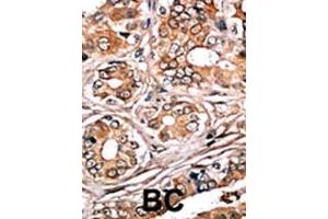 Formalin-fixed and paraffin-embedded human cancer tissue reacted with the primary antibody, which was peroxidase-conjugated to the secondary antibody, followed by AEC staining. (Retinoblastoma 1 anticorps  (pSer780))