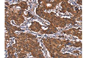The image on the left is immunohistochemistry of paraffin-embedded Human gastric cancer tissue using ABIN7191188(KCNJ9 Antibody) at dilution 1/15, on the right is treated with synthetic peptide. (KCNJ9 anticorps)