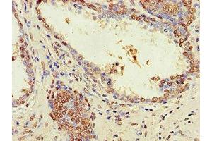 Immunohistochemistry of paraffin-embedded human prostate cancer using ABIN7176555 at dilution of 1:100 (ZNF844 anticorps  (AA 1-300))