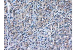 Immunohistochemical staining of paraffin-embedded Adenocarcinoma of Human colon tissue using anti-SNX9 mouse monoclonal antibody. (SNX9 anticorps)
