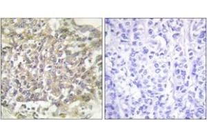 Immunohistochemistry analysis of paraffin-embedded human breast carcinoma tissue, using Shc (Ab-349) Antibody. (SHC1 anticorps  (AA 315-364))