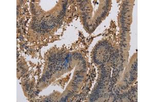 Immunohistochemistry of Human liver cancer using KCNA7 Polyclonal Antibody at dilution of 1:40 (KCNA7 anticorps)