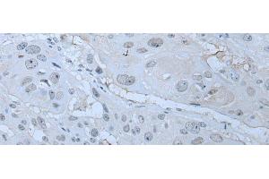 Immunohistochemistry of paraffin-embedded Human esophagus cancer tissue using HUWE1 Polyclonal Antibody at dilution of 1:30(x200) (HUWE1 anticorps)