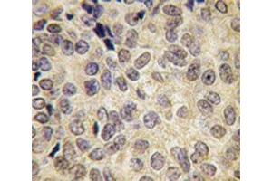 IHC analysis of FFPE human prostate carcinoma tissue stained with Dnmt3b antibody