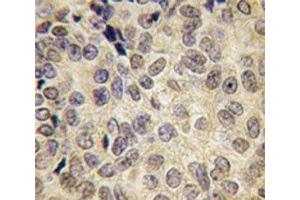 IHC analysis of FFPE human prostate carcinoma tissue stained with Dnmt3b antibody (DNMT3B anticorps  (AA 389-417))