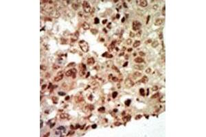 Formalin-fixed and paraffin-embedded human cancer tissue (breast carcinoma) reacted with the primary antibody, which was peroxidase-conjugated to the secondary antibody, followed by AEC staining.