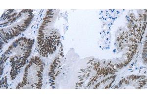 Immunohistochemistry of paraffin-embedded Human colon cancer tissue using RBMS1 Polyclonal Antibody at dilution 1:30