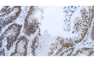 Immunohistochemistry of paraffin-embedded Human colon cancer tissue using RBMS1 Polyclonal Antibody at dilution 1:30 (RBMS1 anticorps)