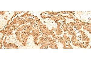 Immunohistochemistry of paraffin-embedded Human thyroid cancer tissue using TIPRL Polyclonal Antibody at dilution of 1:60(x200) (TIPRL anticorps)