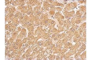 IHC-P Image HSD11B1 antibody detects HSD11B1 protein at cytosol on human hepatoma by immunohistochemical analysis.
