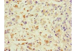 Immunohistochemistry of paraffin-embedded human melanoma using ABIN7172232 at dilution of 1:100 (TRAF2 anticorps  (AA 147-281))