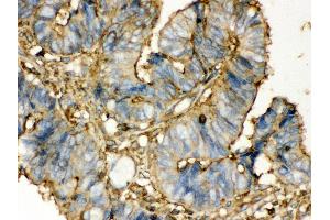 Anti- TGM2 Picoband antibody, IHC(P) IHC(P): Human Intestinal Cancer Tissue