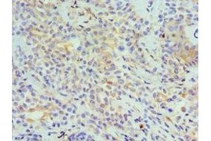 Immunohistochemistry of paraffin-embedded human breast cancer using ABIN7173799 at dilution of 1:100