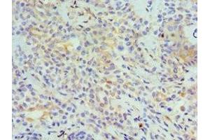 Immunohistochemistry of paraffin-embedded human breast cancer using ABIN7173799 at dilution of 1:100 (TNFSF13 anticorps  (AA 105-247))