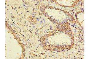 Immunohistochemistry of paraffin-embedded human prostate cancer using ABIN7169312 at dilution of 1:100