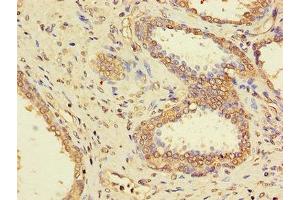 Immunohistochemistry of paraffin-embedded human prostate cancer using ABIN7169312 at dilution of 1:100 (PPP1CC anticorps  (Catalytic Subunit))