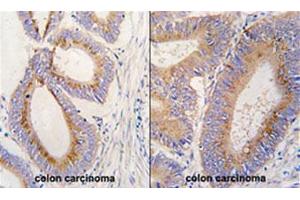 Formalin-fixed and paraffin-embedded human colon carcinoma tissue reacted with GDF11 polyclonal antibody  , which was peroxidase-conjugated to the secondary antibody, followed by DAB staining. (GDF11 anticorps  (N-Term))