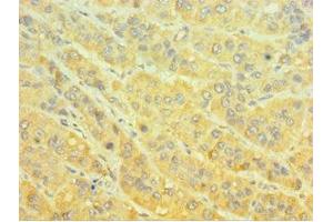 Immunohistochemistry of paraffin-embedded human liver cancer using ABIN7160651 at dilution of 1:100 (MTMR4 anticorps  (AA 570-820))