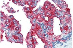 Human Prostate (formalin-fixed, paraffin-embedded) stained with FOLH1 antibody ABIN364431 at 10 ug/ml followed by biotinylated anti-mouse IgG secondary antibody ABIN481714, alkaline phosphatase-streptavidin and chromogen. (PSMA anticorps)