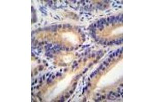 HSD11B1L Antibody : immunohistochemistry analysis in formalin fixed and paraffin embedded human prostate carcinoma followed by peroxidase conjugation of the secondary antibody and DAB staining. (HSD11B1L anticorps  (C-Term))