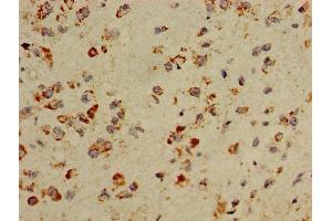 Immunohistochemistry of paraffin-embedded human glioma using ABIN7149167 at dilution of 1:100