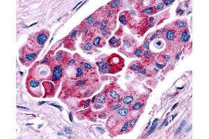 Anti-TRH Receptor / TRHR antibody IHC of human Lung, Non-Small Cell Carcinoma. (TRHR anticorps  (C-Term))